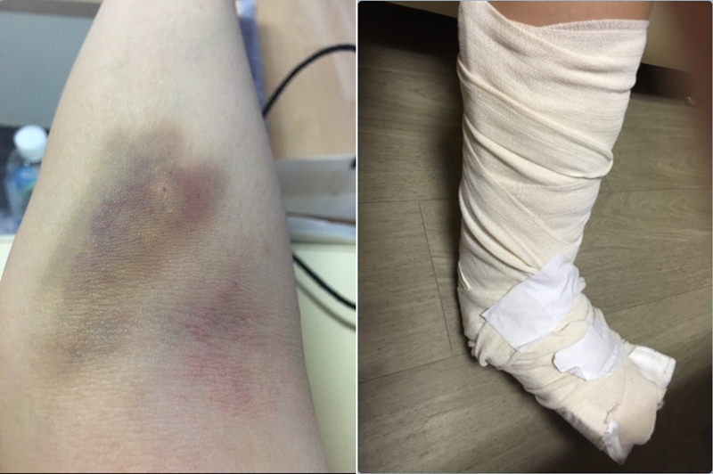 ▲ 멍 자국(왼쪽)과 2015년 12월 발목 깁스 사진. B씨는 이에 대해 정맥 주사 바늘 자국일 수 있으며, 대학병원 의사가 한 깁스같지 않다고 반박했다.