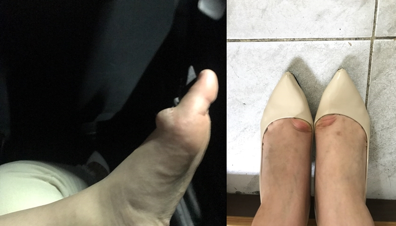 ▲ (주)케이에이 지상직 여성 직원들의 발 변형 모습. 왼쪽 사진은 결정종 진단을 받은 직원의 발이고 오른쪽은 발에 변형이 온 직원의 사진이다.