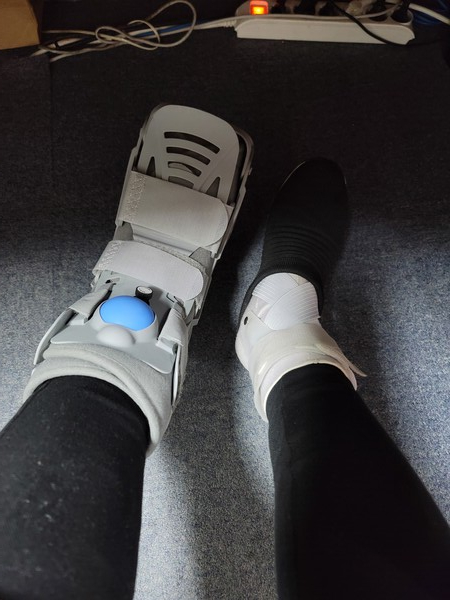 ▲ 2022년 12월 오른쪽에 이어 왼쪽 인대까지 다친 모습. 사진=본인 제공